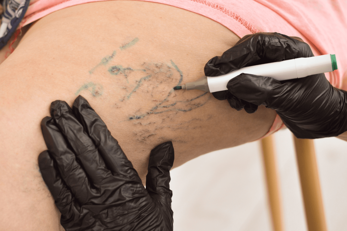 spider veins treatment sclerotherapy in miami