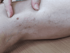 spider veins treatment with sclerotherapy in coral gables