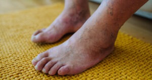 A vein specialist from Miami Vein Institute in Coral Gables examining a patient’s leg discoloration to explain why legs change color.